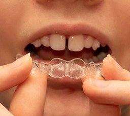 Close up of teen holding a clear aligner