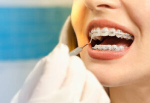 Close up of woman’s mouth with braces